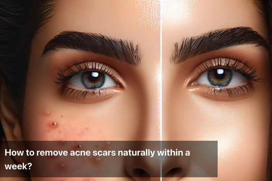 Before and after image of acne scars removal naturally