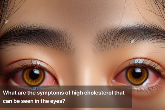 Close-up of eyes showing symptoms of high cholesterol