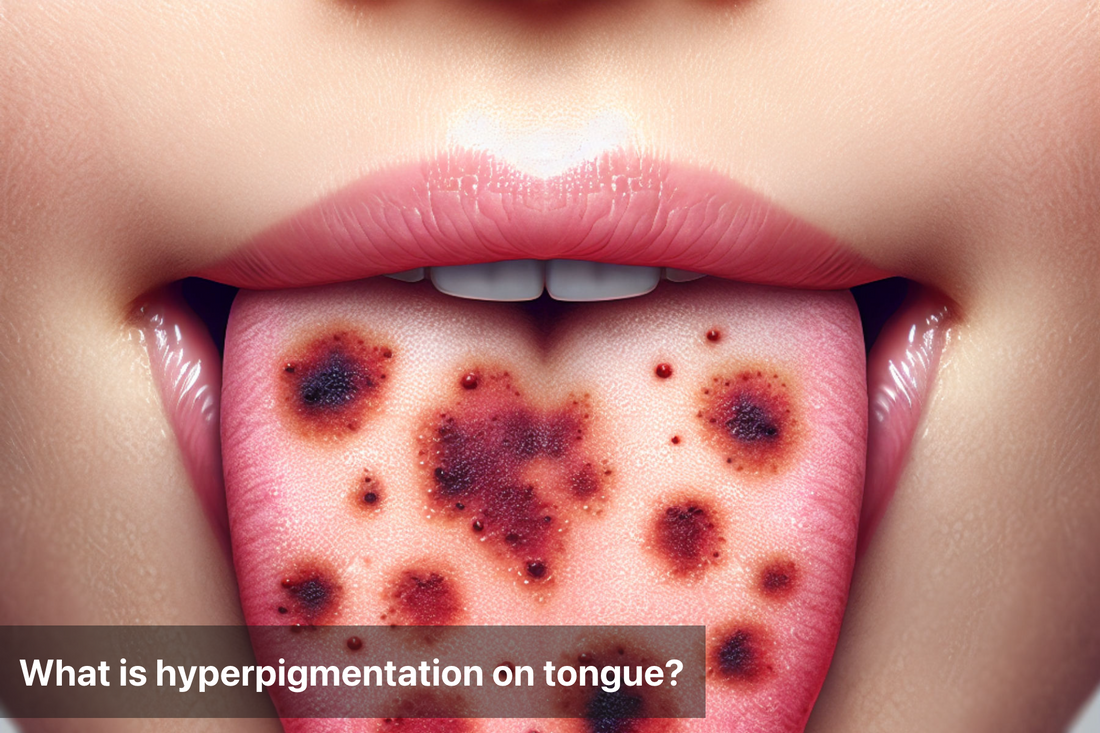 Close-up of a tongue showing hyperpigmentation spots