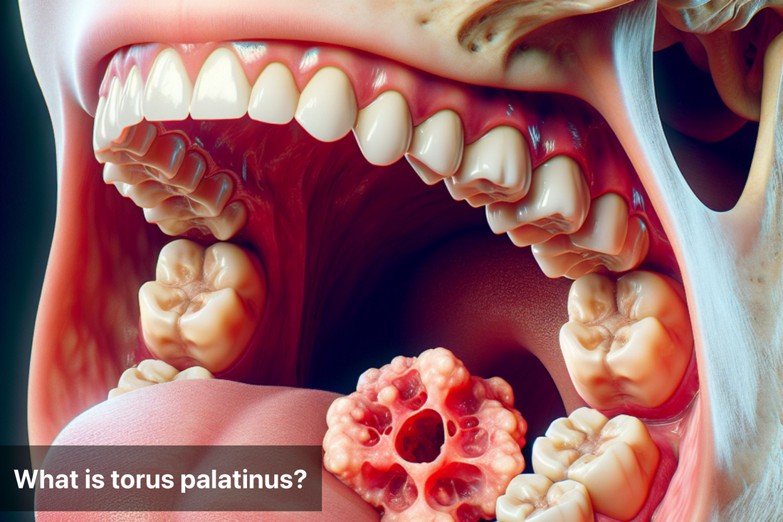 Diagram of a mouth showing torus palatinus formation