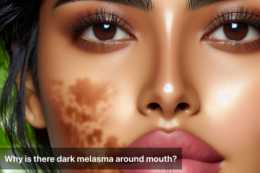 Close-up of a woman's face showing dark melasma around mouth.